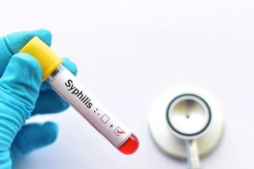 Aumento de casos de sífilis en Argentina: más de 50 mil diagnósticos