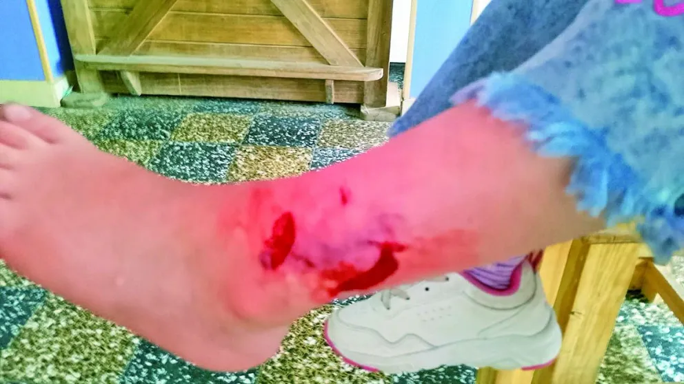 Preocupación en Próspero Palazzo: un perro mordió a una niña en plena plaza